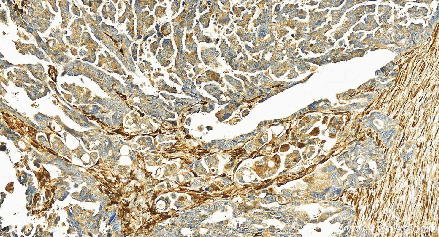 Immunohistochemistry (IHC) staining of human ovary cancer tissue using CaMKIV Polyclonal antibody (13263-1-AP)