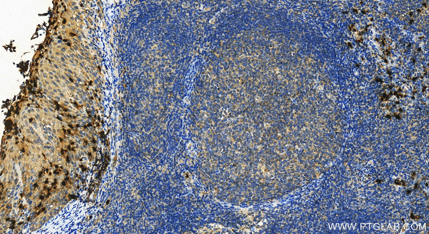 Immunohistochemistry (IHC) staining of human tonsillitis tissue using CAMP Polyclonal antibody (12009-1-AP)