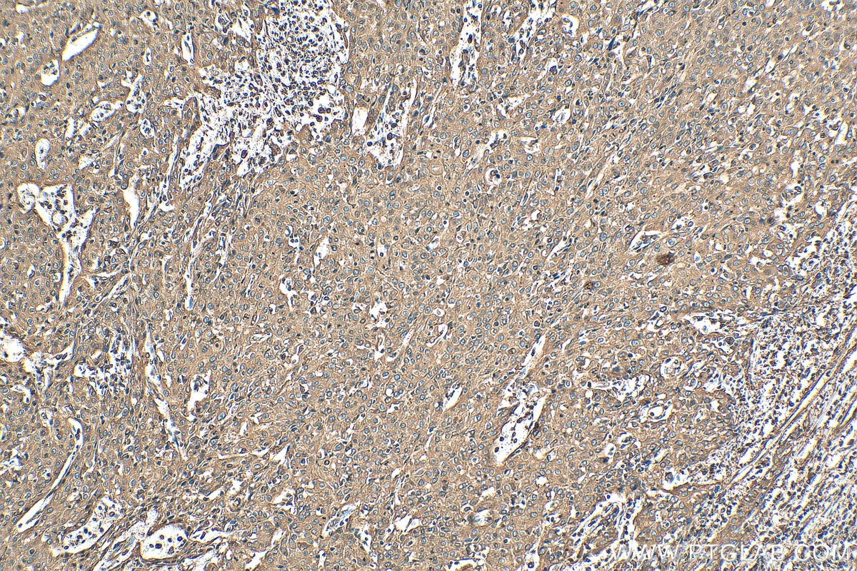 Immunohistochemistry (IHC) staining of human cervical cancer tissue using Calnexin Polyclonal antibody (10427-2-AP)