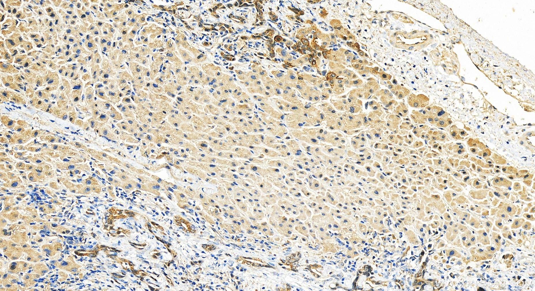 Immunohistochemistry (IHC) staining of human intrahepatic cholangiocarcinoma tissue using Calpain 6 Polyclonal antibody (10120-1-AP)