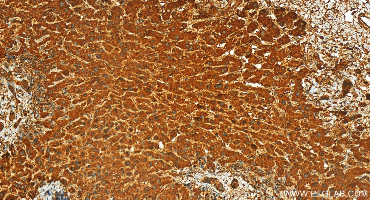 Immunohistochemistry (IHC) staining of human intrahepatic cholangiocarcinoma tissue using Calpain 7 Polyclonal antibody (13870-1-AP)