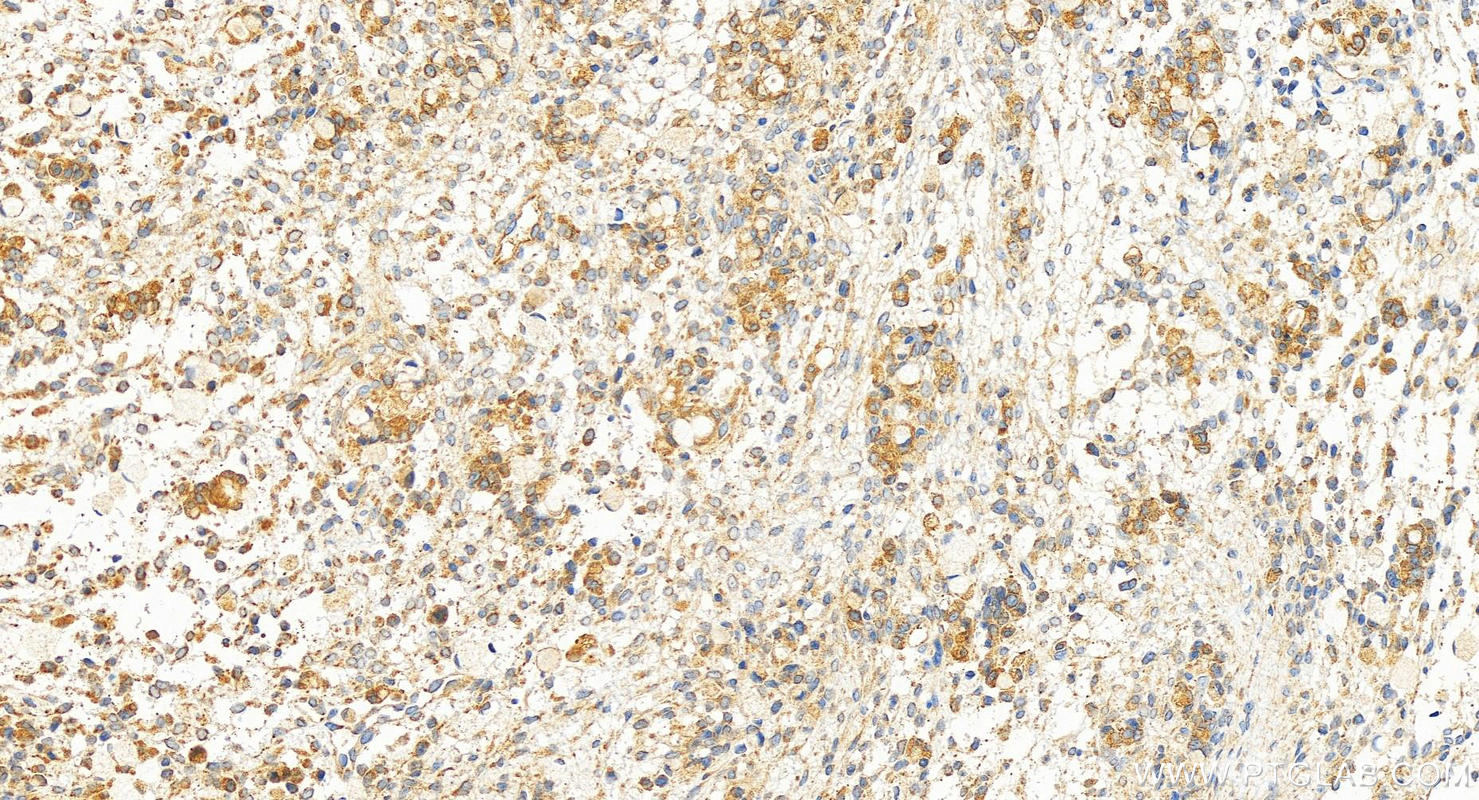 Immunohistochemistry (IHC) staining of human ovary cancer tissue using Calpain 7 Polyclonal antibody (13870-1-AP)