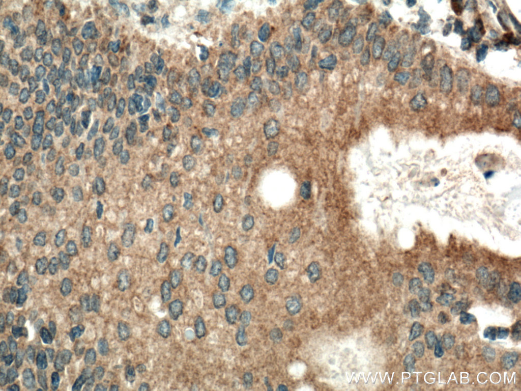 Immunohistochemistry (IHC) staining of human stomach cancer tissue using CAPN8 Polyclonal antibody (20971-1-AP)