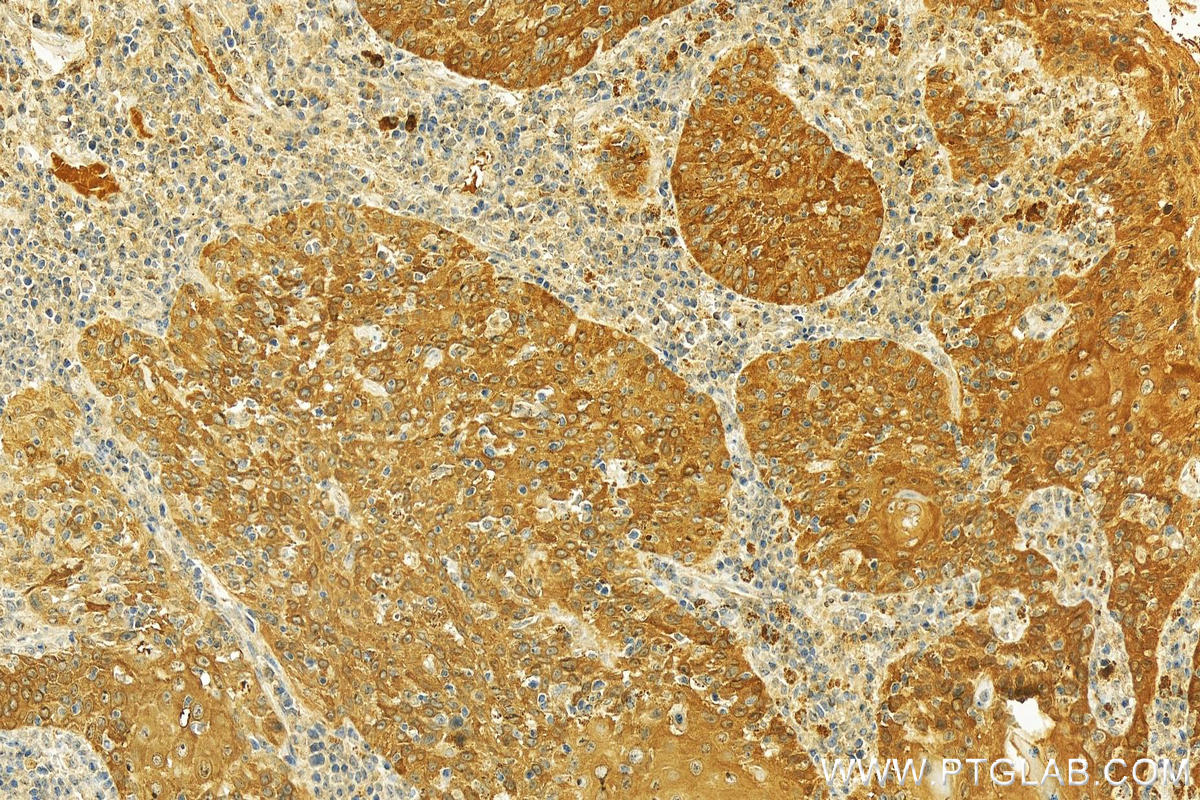 Immunohistochemistry (IHC) staining of human skin cancer tissue using Calpain S2 Polyclonal antibody (15803-1-AP)