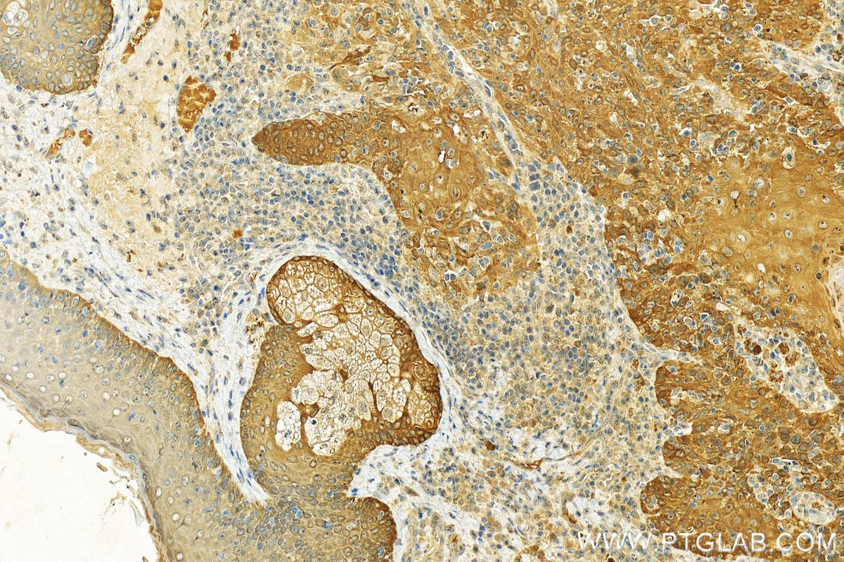 Immunohistochemistry (IHC) staining of human skin cancer tissue using Calpain S2 Polyclonal antibody (15803-1-AP)