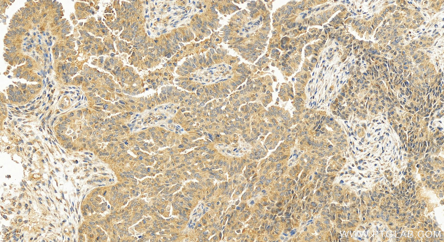 Immunohistochemistry (IHC) staining of human ovarian cancer using CAPZA1 Polyclonal antibody (11806-1-AP)