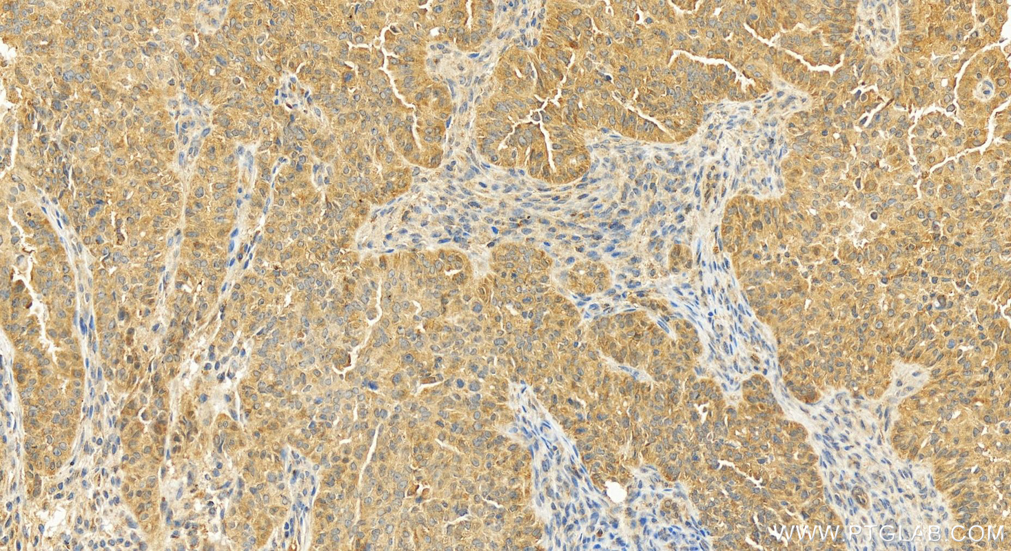 Immunohistochemistry (IHC) staining of human ovarian cancer using CAPZA1 Polyclonal antibody (11806-1-AP)