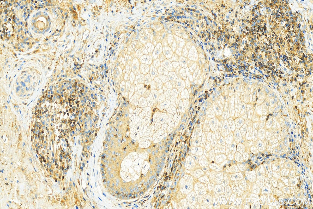 Immunohistochemistry (IHC) staining of human skin cancer tissue using CAPZA1 Monoclonal antibody (66066-1-Ig)