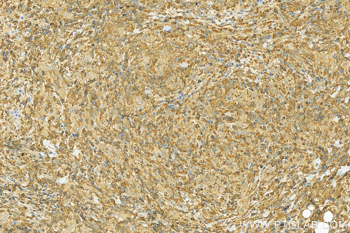 Immunohistochemistry (IHC) staining of human skin cancer tissue using CAPZB Polyclonal antibody (25043-1-AP)