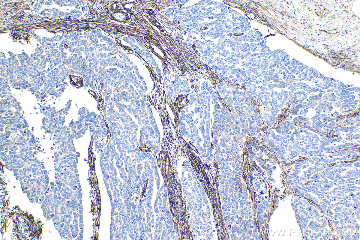 Immunohistochemistry (IHC) staining of human ovary tumor tissue using Caveolin-1 Monoclonal antibody (66067-1-Ig)