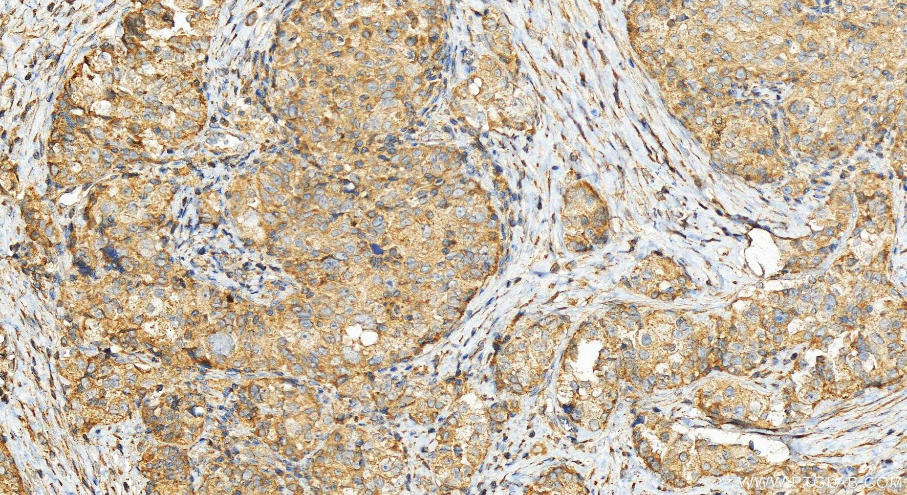 Immunohistochemistry (IHC) staining of human ovary cancer tissue using CBARA1 Polyclonal antibody (25905-1-AP)