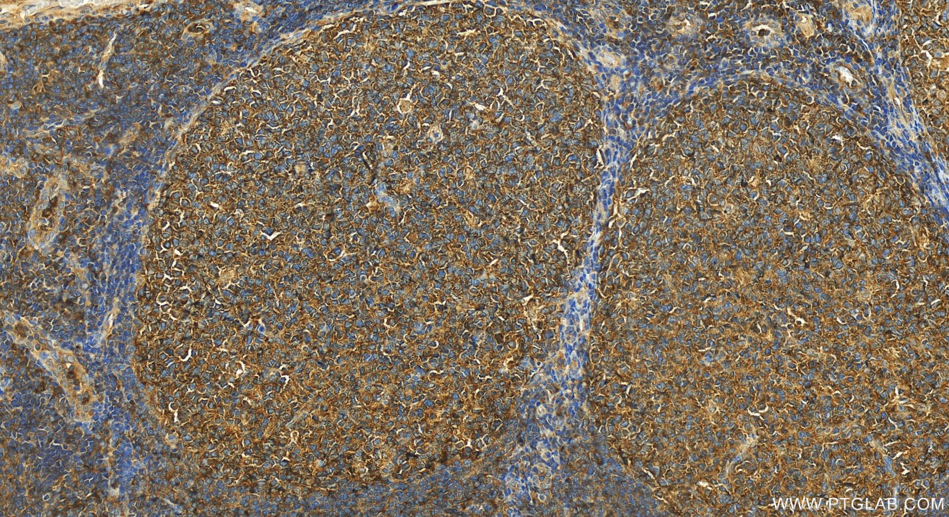 Immunohistochemistry (IHC) staining of human tonsillitis tissue using c-Cbl Polyclonal antibody (25818-1-AP)