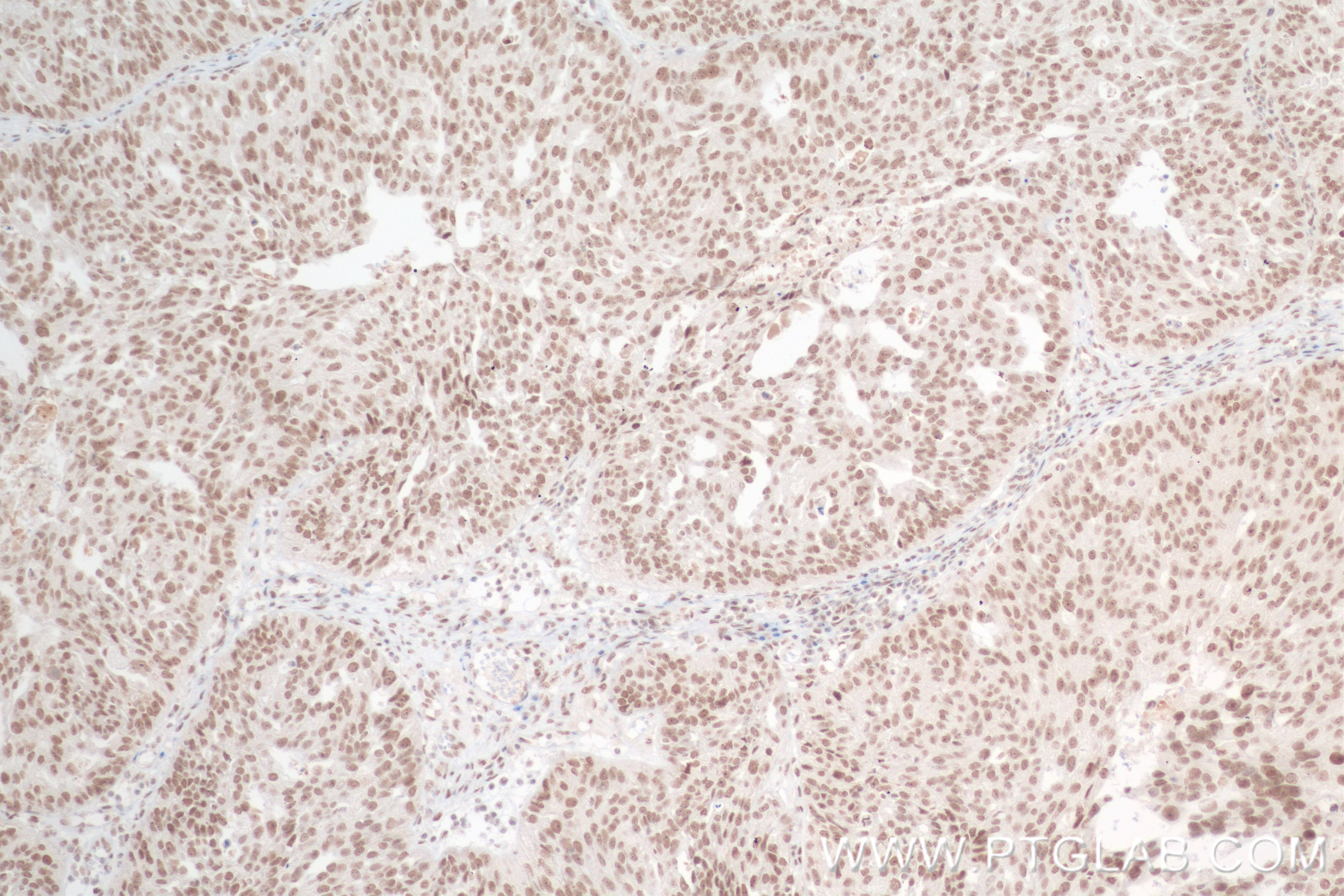 Immunohistochemistry (IHC) staining of human ovary cancer tissue using NCBP1/CBP80 Recombinant antibody (83212-4-RR)