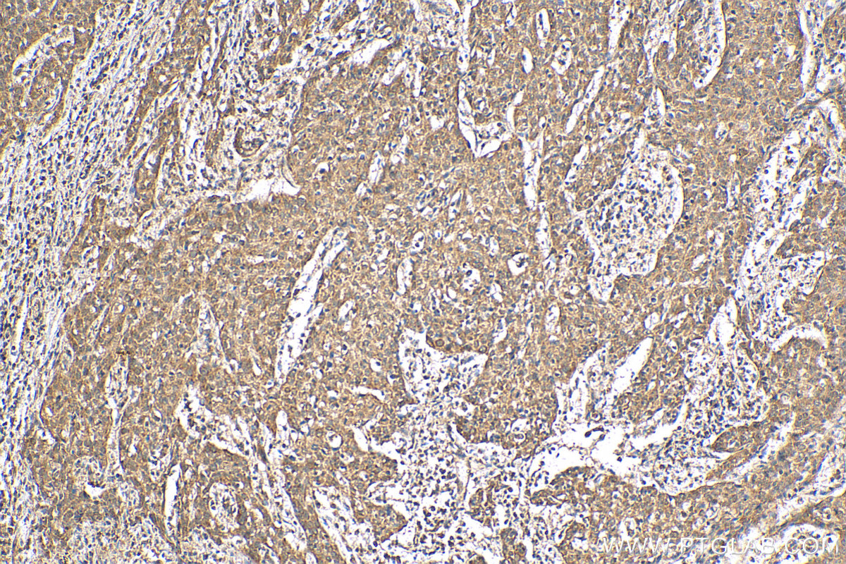 Immunohistochemistry (IHC) staining of human cervical cancer tissue using CWC25 Polyclonal antibody (24416-1-AP)