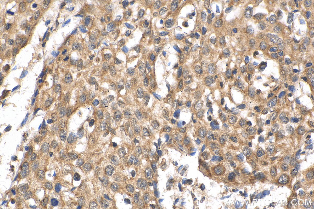 Immunohistochemistry (IHC) staining of human cervical cancer tissue using CWC25 Polyclonal antibody (24416-1-AP)