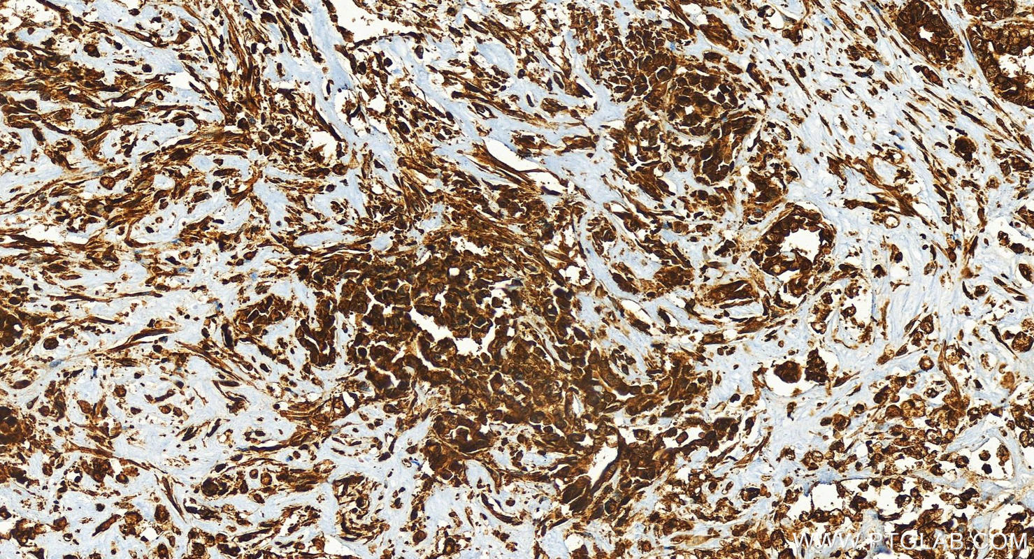 Immunohistochemistry (IHC) staining of human intrahepatic cholangiocarcinoma tissue using CCDC94 Recombinant antibody (83580-5-RR)