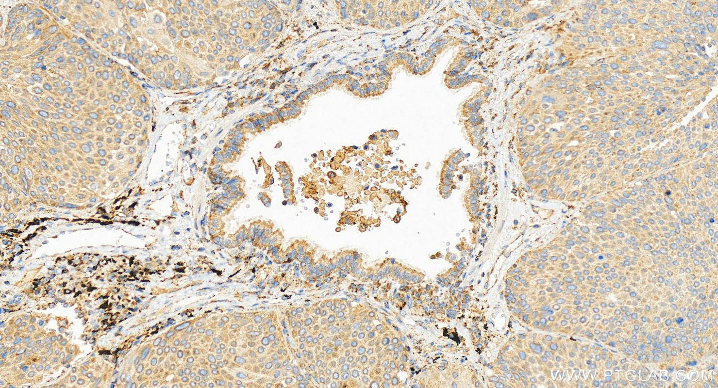 Immunohistochemistry (IHC) staining of human lung squamous cell carcinoma tissue using CCL11/Eotaxin Polyclonal antibody (11786-1-AP)