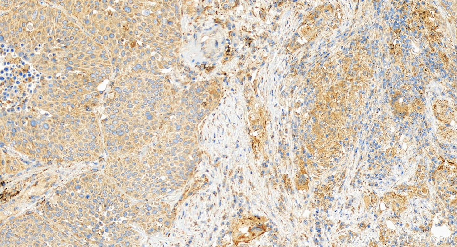 Immunohistochemistry (IHC) staining of human lung squamous cell carcinoma tissue using CCL11/Eotaxin Polyclonal antibody (11786-1-AP)