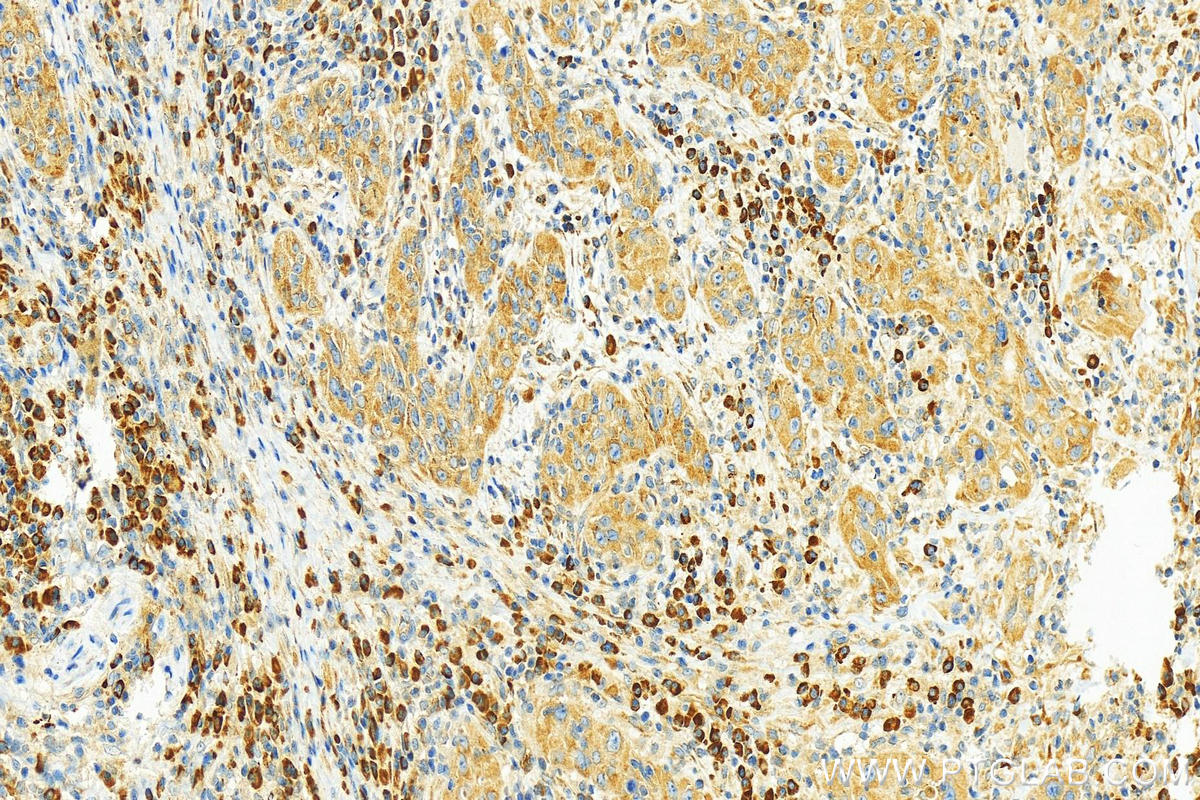 Immunohistochemistry (IHC) staining of human skin cancer tissue using Cyclin B1 Polyclonal antibody (55004-1-AP)