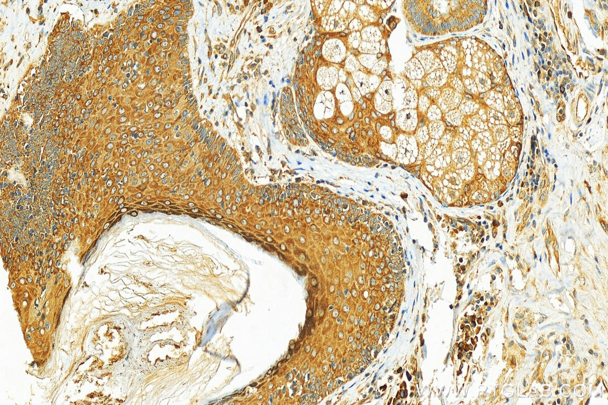 Immunohistochemistry (IHC) staining of human skin cancer tissue using Cyclin B1 Polyclonal antibody (55004-1-AP)