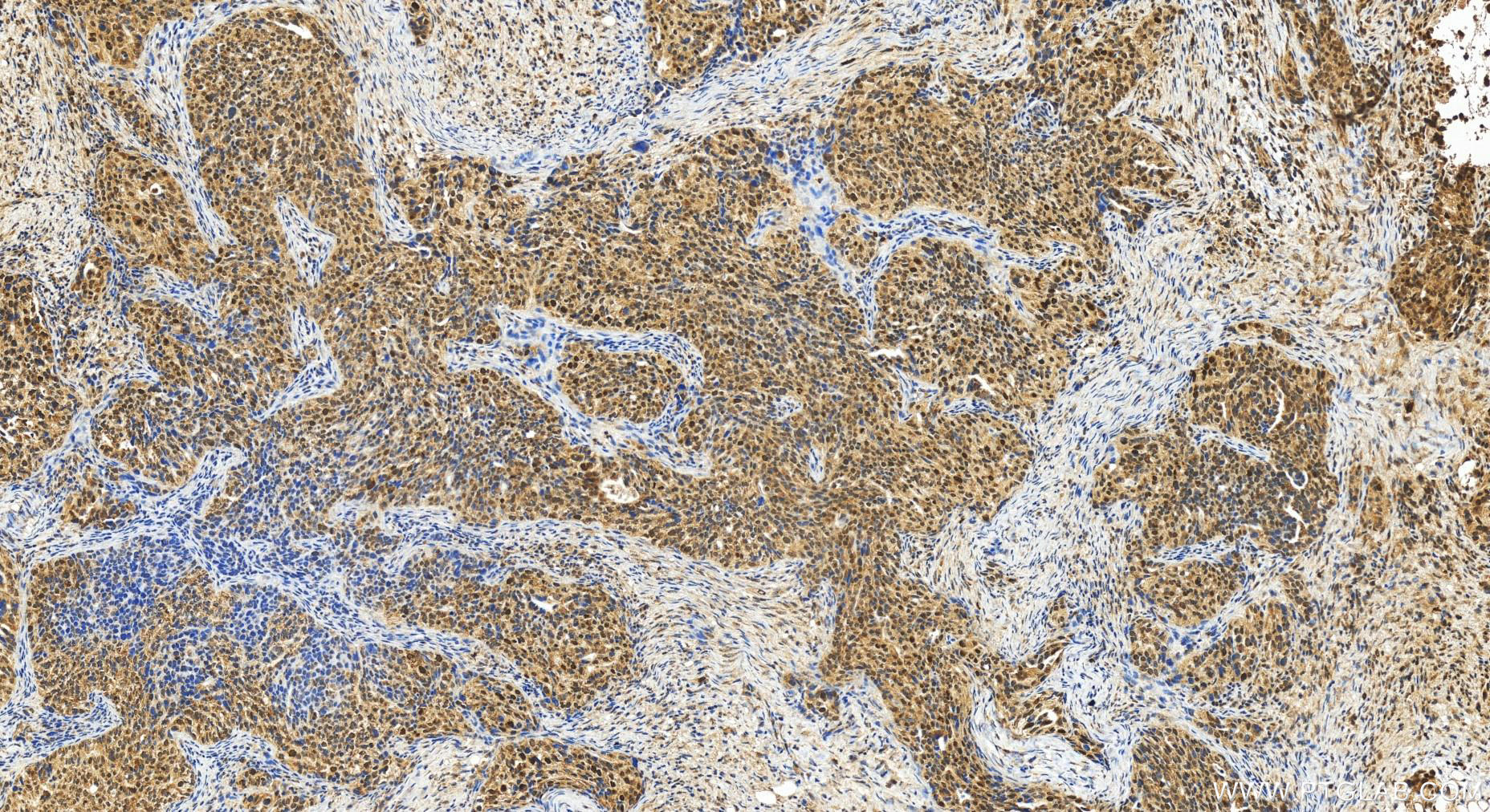 Immunohistochemistry (IHC) staining of human ovary cancer tissue using Cyclin T1 Polyclonal antibody (20992-1-AP)