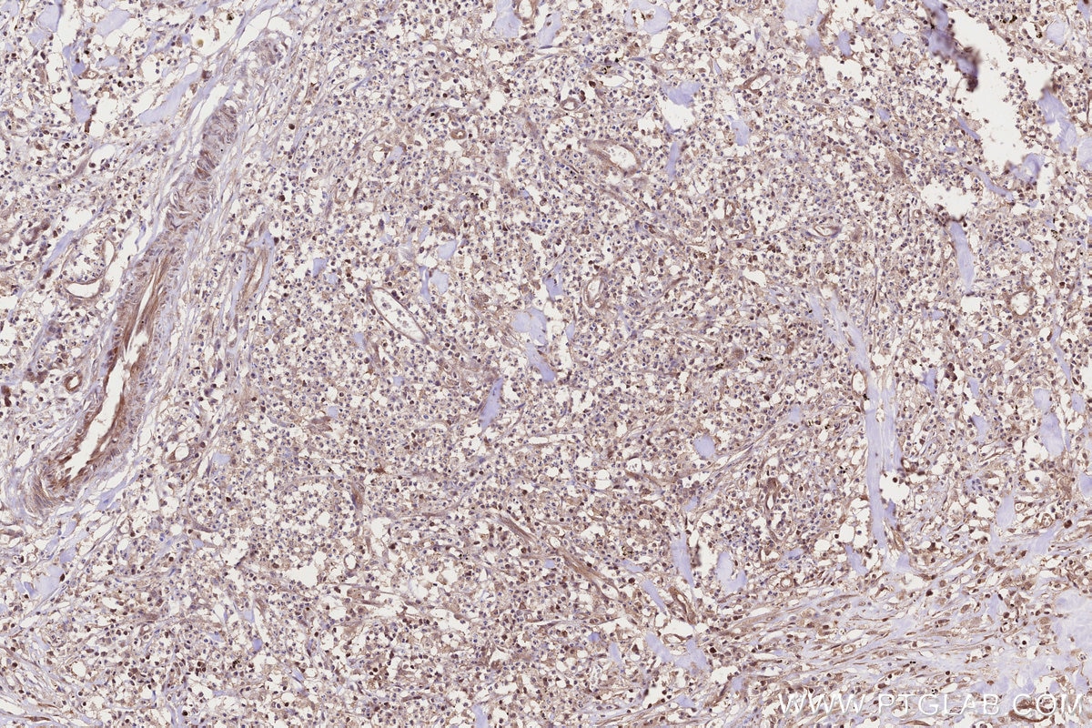 Immunohistochemistry (IHC) staining of human colon cancer tissue using CCT4 Polyclonal antibody (21524-1-AP)