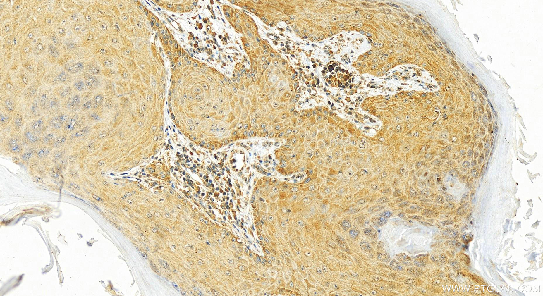 Immunohistochemistry (IHC) staining of human skin cancer tissue using CCT5 Monoclonal antibody (67400-1-Ig)