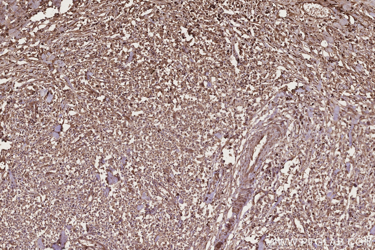 Immunohistochemistry (IHC) staining of human colon cancer tissue using CCT8 Monoclonal antibody (67539-1-Ig)