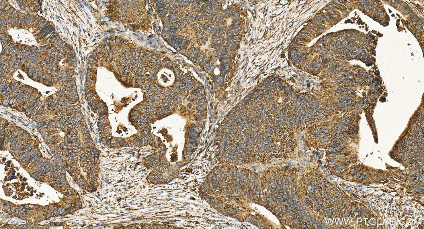 Immunohistochemistry (IHC) staining of human colon cancer tissue using CD107a / LAMP1 Polyclonal antibody (21997-1-AP)