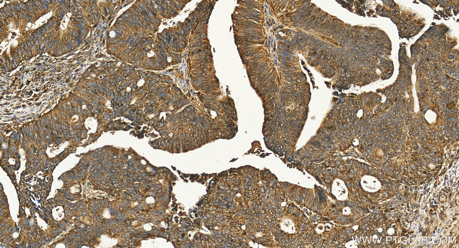 Immunohistochemistry (IHC) staining of human colon cancer tissue using CD107a / LAMP1 Polyclonal antibody (21997-1-AP)
