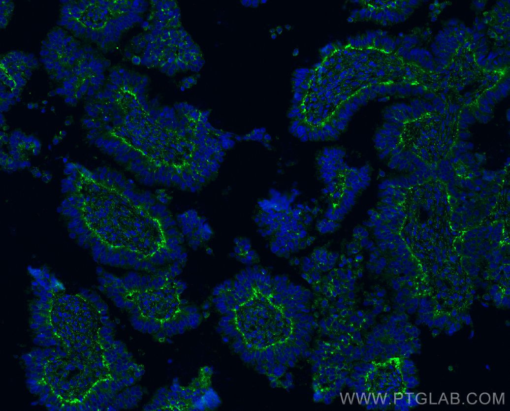 Immunofluorescence (IF) / fluorescent staining of human ovary tumor tissue using CD107a / LAMP1 Polyclonal antibody (21997-1-AP)