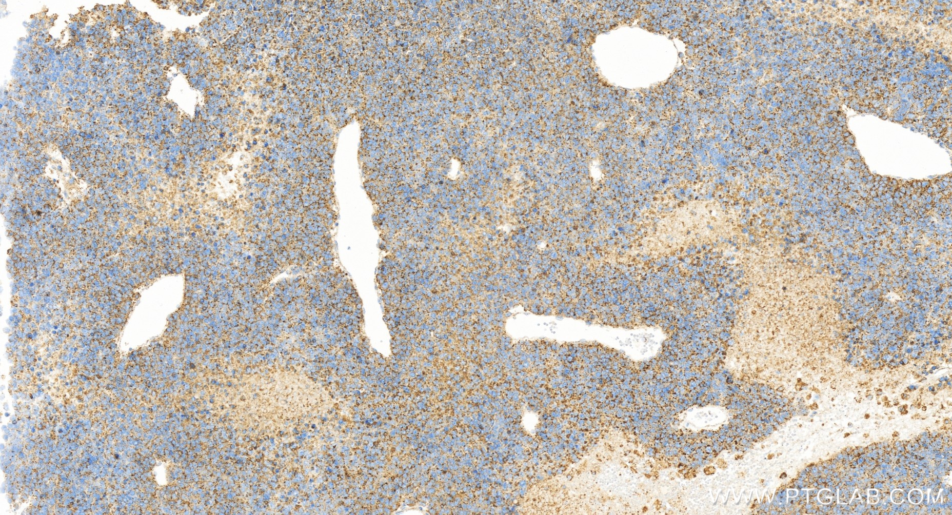 Immunohistochemistry (IHC) staining of human liver cancer tissue using CD107a / LAMP1 Recombinant antibody (84658-5-RR)