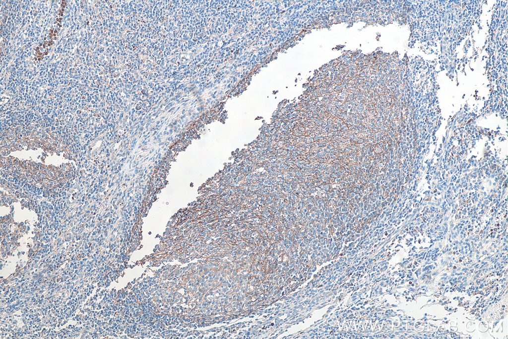 Immunohistochemistry (IHC) staining of human tonsillitis tissue using CD11b Monoclonal antibody (66519-1-Ig)