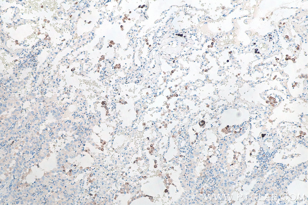Immunohistochemistry (IHC) staining of human lung cancer tissue using CD11b Monoclonal antibody (66519-1-Ig)