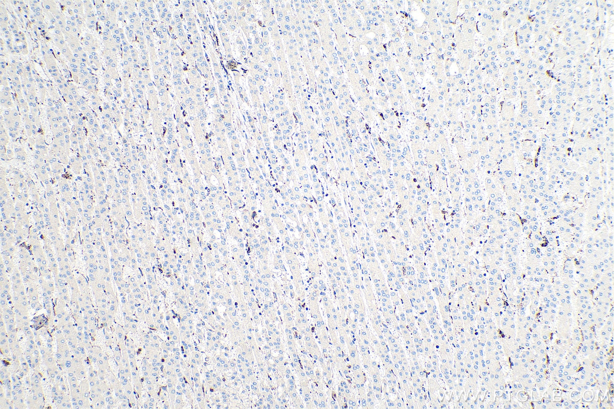 Immunohistochemistry (IHC) staining of human liver cancer tissue using CD11b Monoclonal antibody (66519-1-Ig)