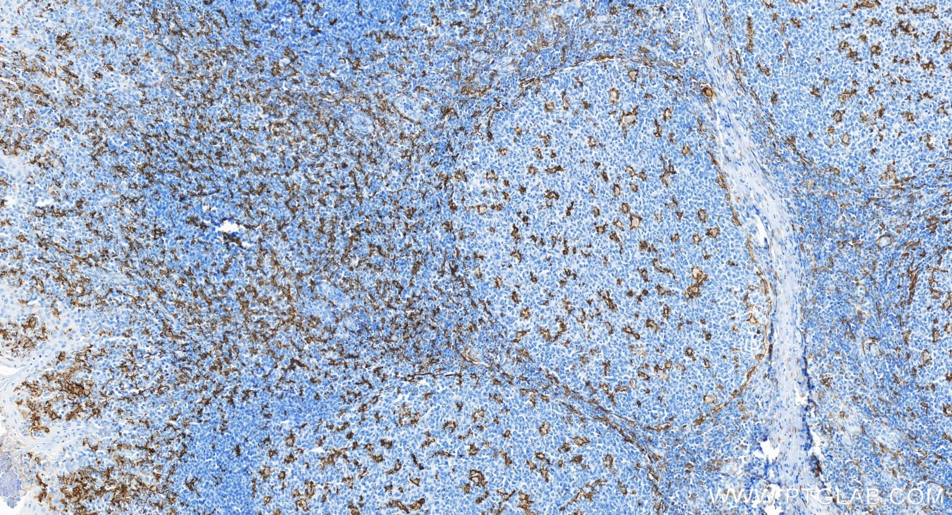 Immunohistochemistry (IHC) staining of human tonsillitis tissue using CD11c/Integrin alpha X Recombinant antibody (81853-1-RR)