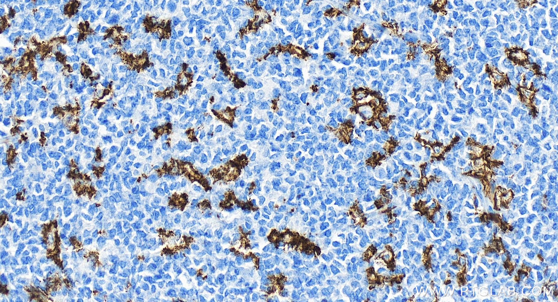 Immunohistochemistry (IHC) staining of human tonsillitis tissue using CD11c/Integrin alpha X Recombinant antibody (81853-1-RR)