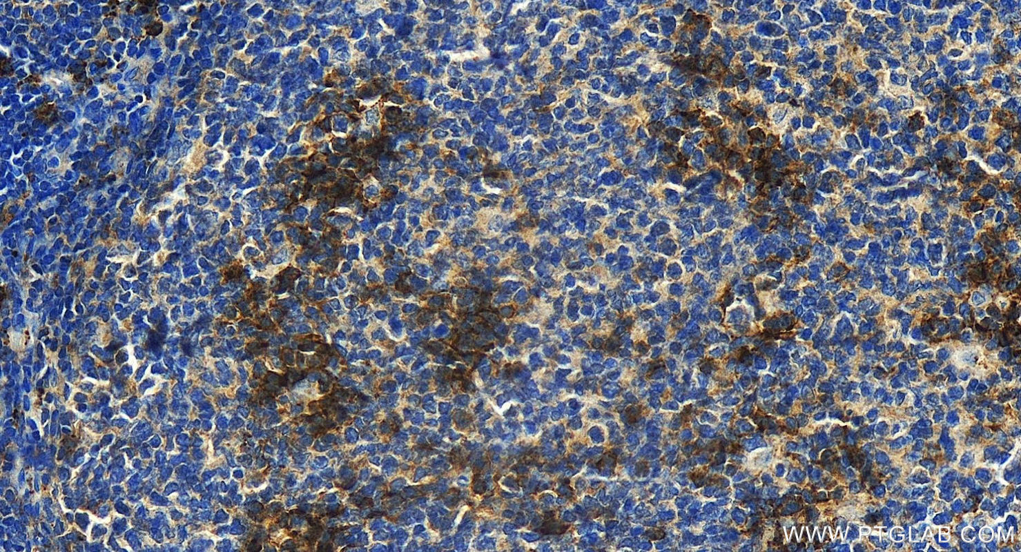 Immunohistochemistry (IHC) staining of human tonsillitis tissue using CD138/Syndecan-1 Polyclonal antibody (31341-1-AP)