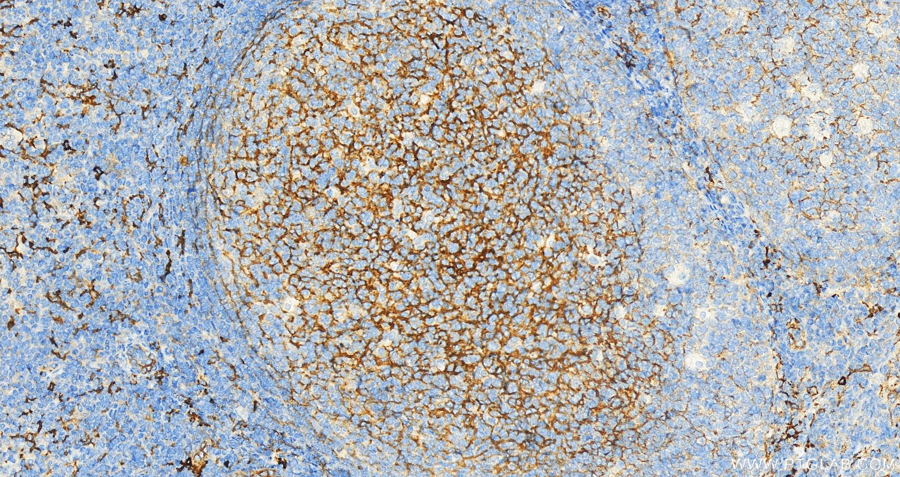 Immunohistochemistry (IHC) staining of human tonsillitis tissue using CD14 Polyclonal antibody (17000-1-AP)