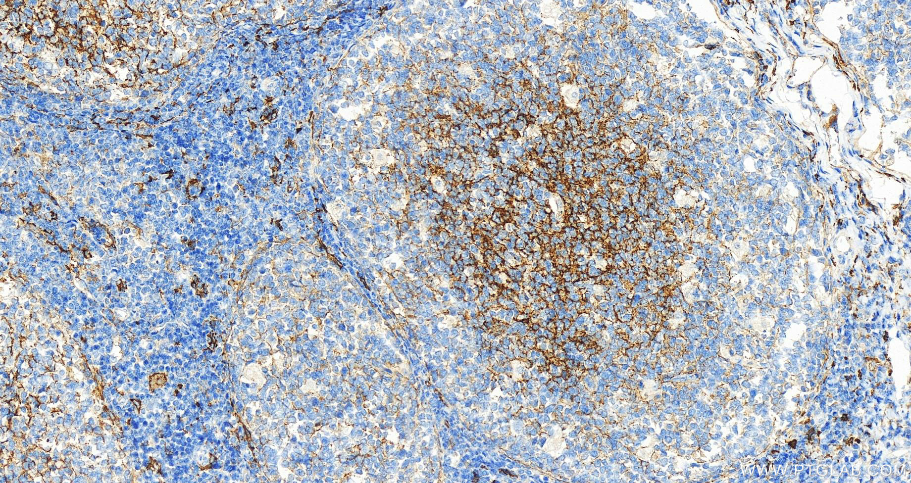 Immunohistochemistry (IHC) staining of human tonsillitis tissue using CD14 Polyclonal antibody (17000-1-AP)