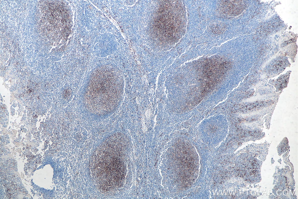 Immunohistochemistry (IHC) staining of human tonsillitis tissue using CD14 Monoclonal antibody (60253-1-Ig)