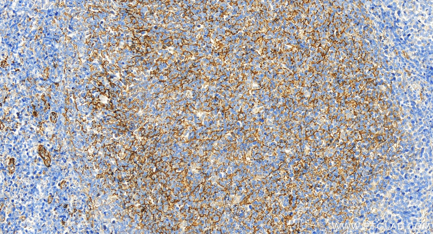 Immunohistochemistry (IHC) staining of human tonsillitis tissue using CD14 Monoclonal antibody (60253-1-Ig)