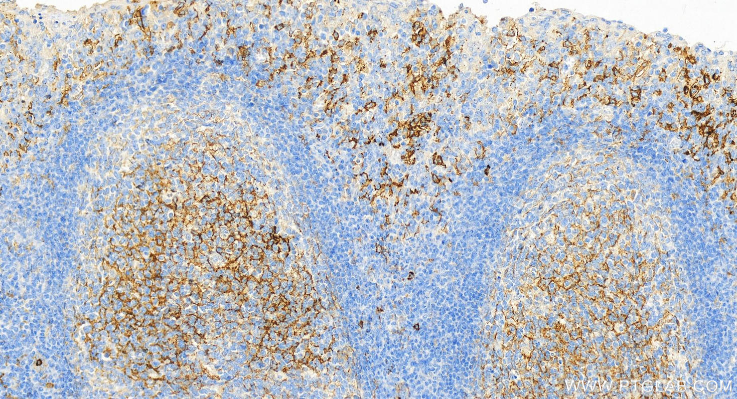 Immunohistochemistry (IHC) staining of human tonsillitis tissue using CD14 Monoclonal antibody (60253-1-Ig)