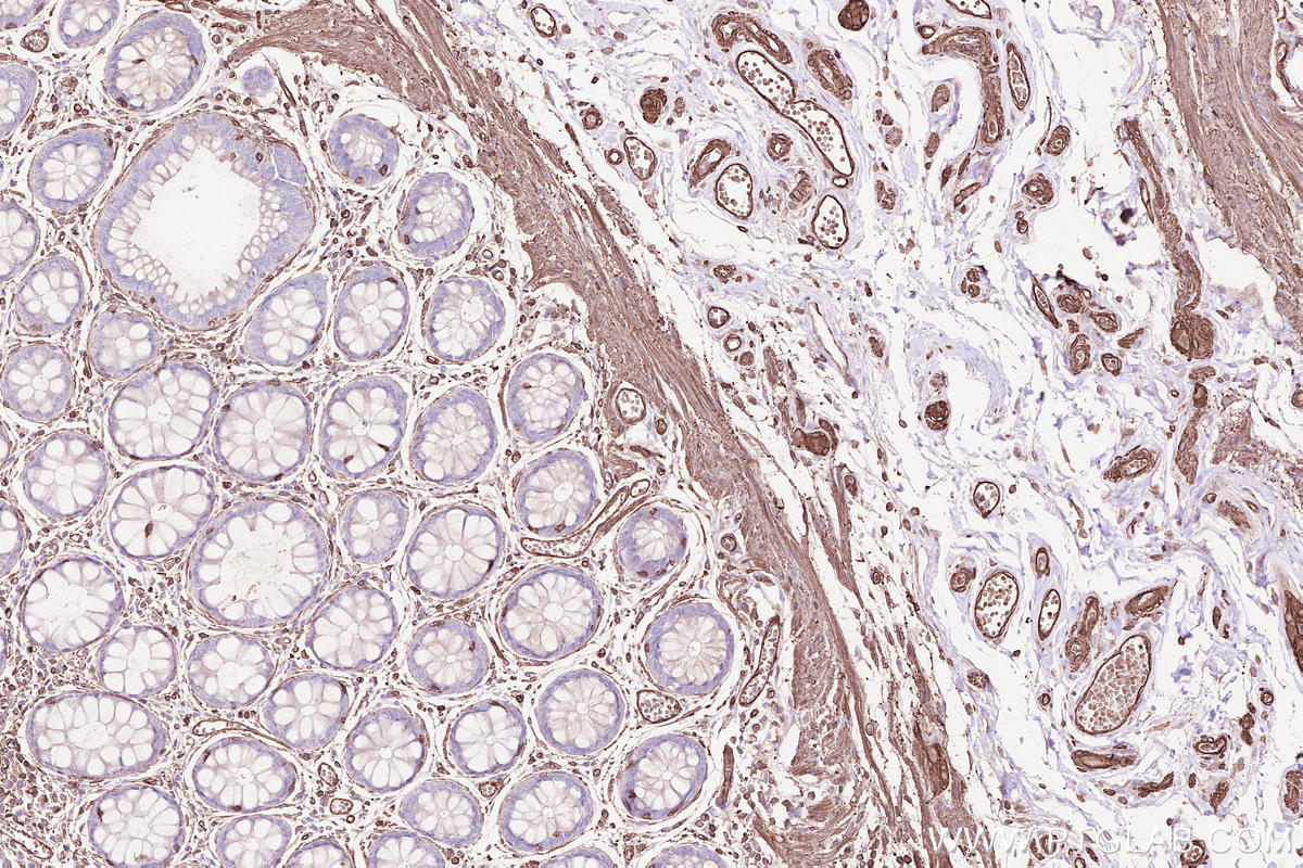 Immunohistochemistry (IHC) staining of human rectal cancer tissue using CD146/MCAM Monoclonal antibody (66153-1-Ig)