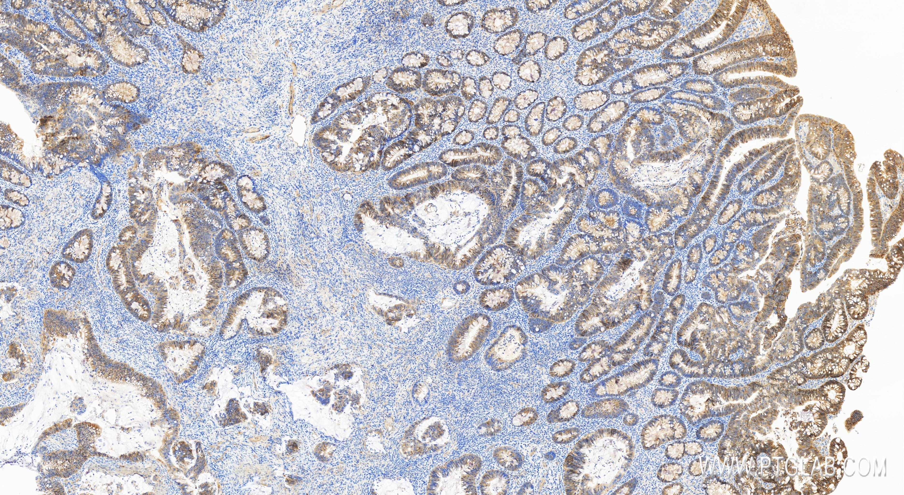 Immunohistochemistry (IHC) staining of human colon cancer tissue using CD155/PVR Recombinant antibody (84138-5-RR)