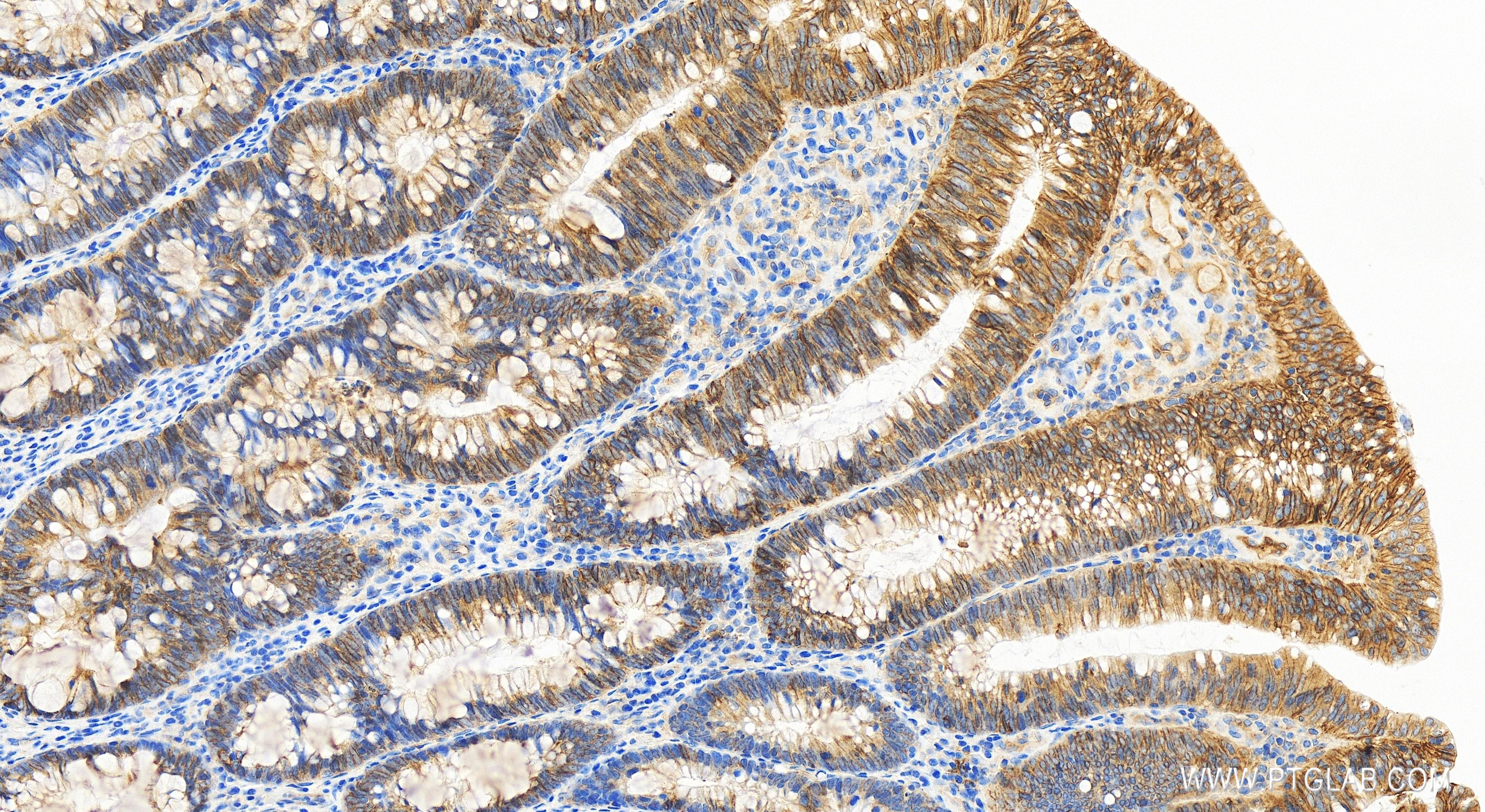 Immunohistochemistry (IHC) staining of human colon cancer tissue using CD155/PVR Recombinant antibody (84138-5-RR)