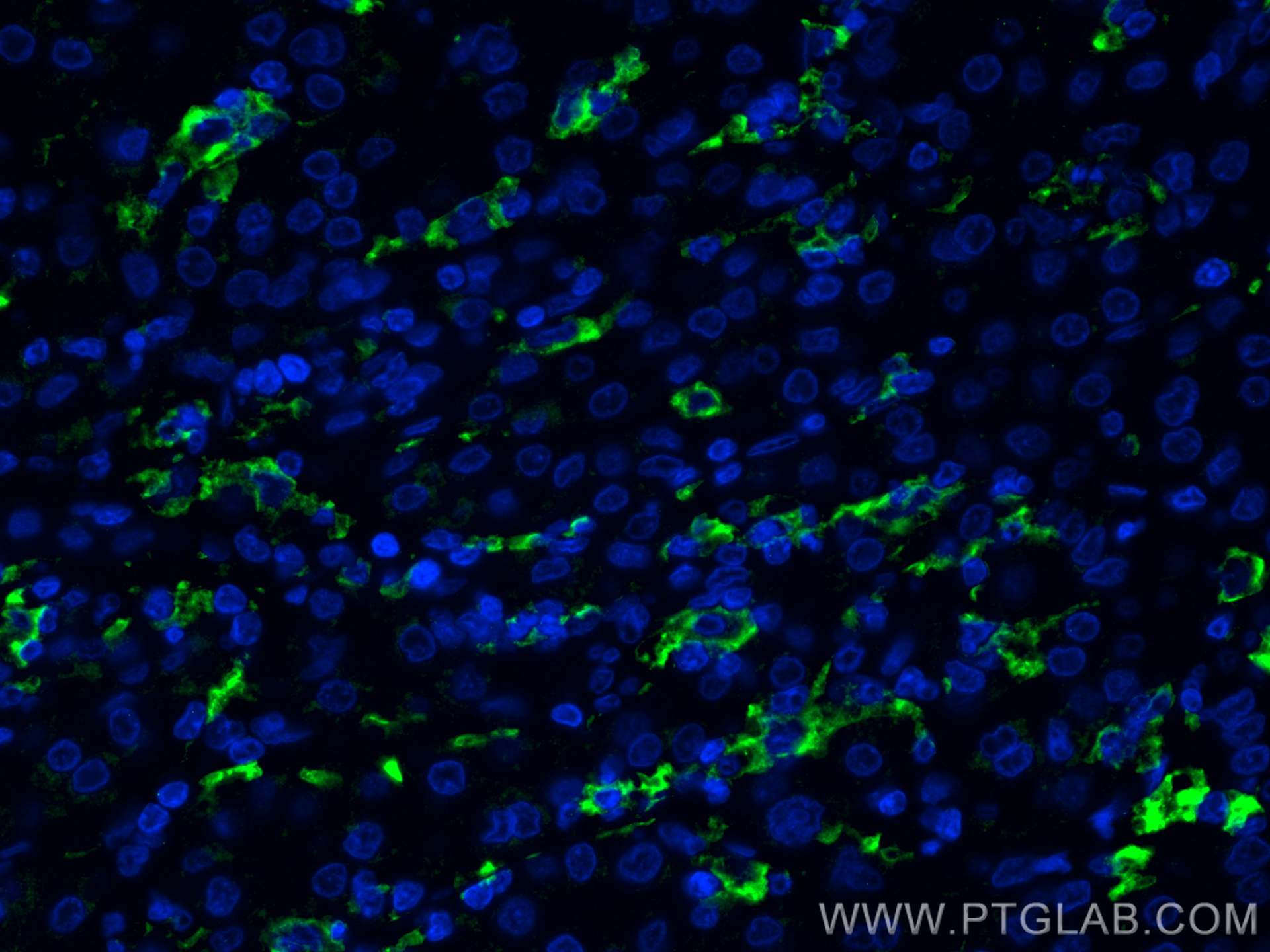 Immunofluorescence (IF) / fluorescent staining of human liver cancer tissue using CD16 Polyclonal antibody (16559-1-AP)