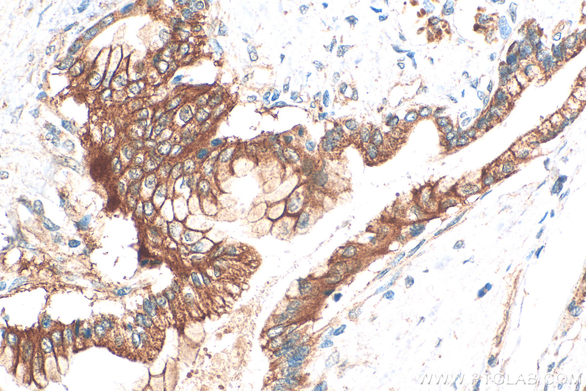 Immunohistochemistry (IHC) staining of human pancreas cancer tissue using CD164L2 Polyclonal antibody (25488-1-AP)