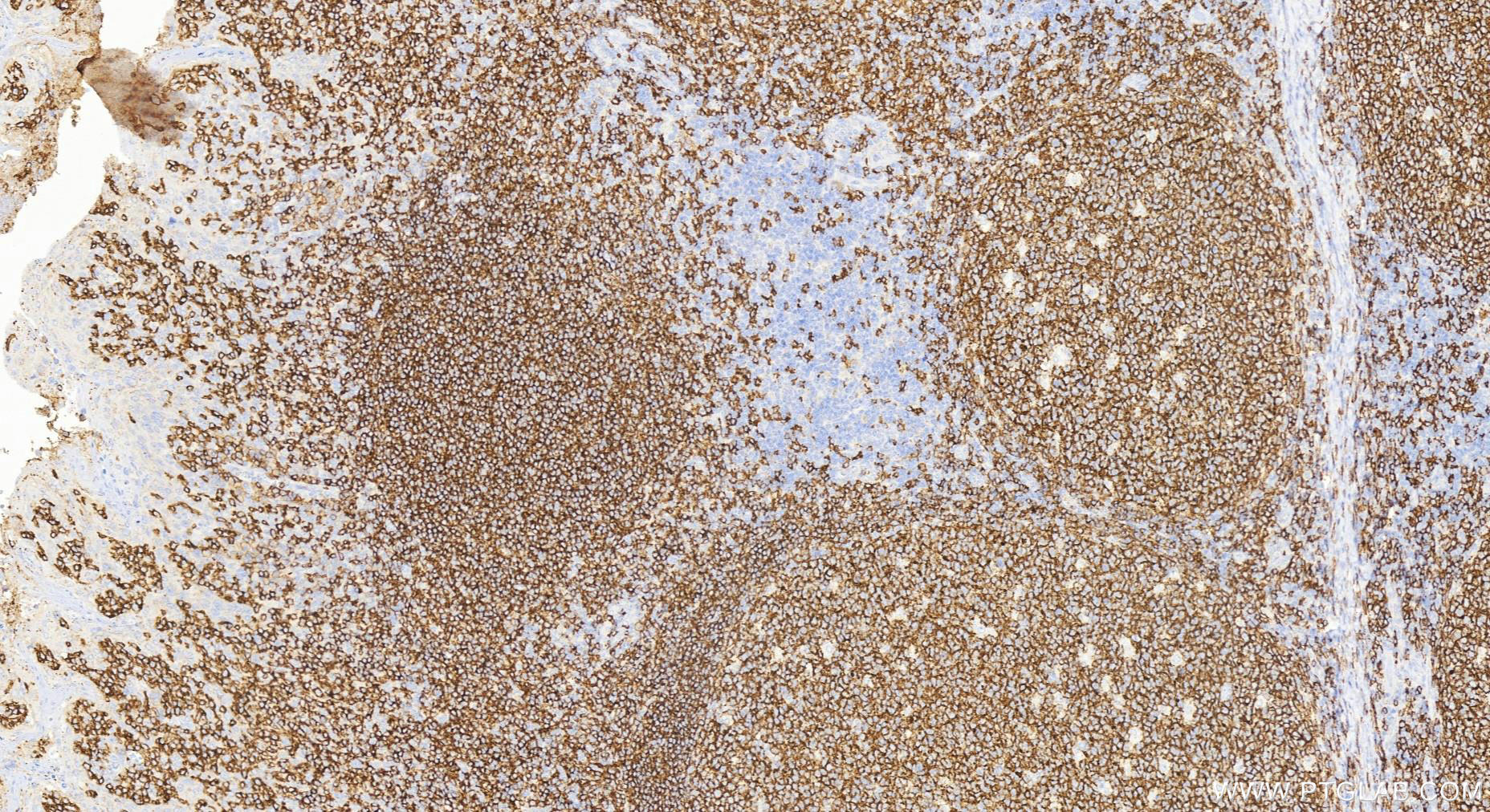 Immunohistochemistry (IHC) staining of human tonsillitis tissue using CD19 Polyclonal antibody (27949-1-AP)