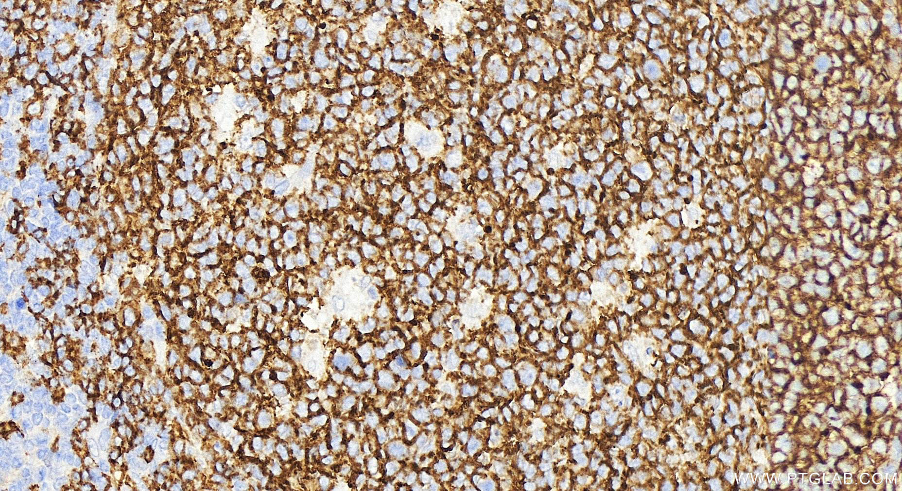 Immunohistochemistry (IHC) staining of human tonsillitis tissue using CD19 Polyclonal antibody (27949-1-AP)